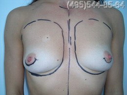 Пластическая операция по увеличению груди - фото до операции