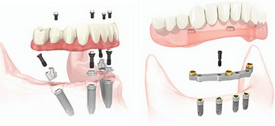 Имплантация всех зубов в Изариле